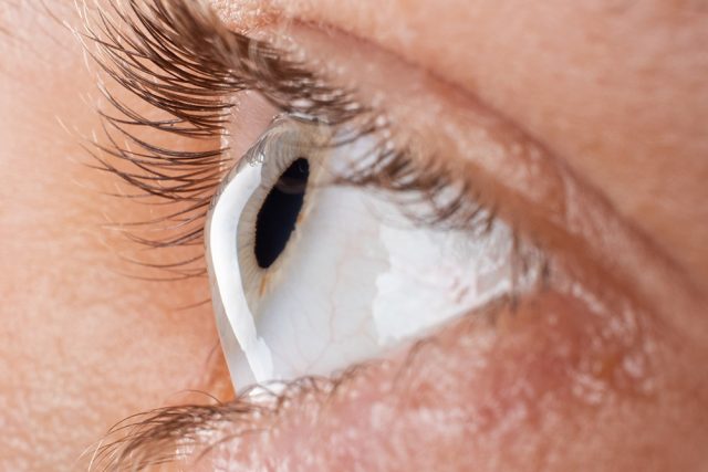female eye diagnosed with keratoconus corneal thinning